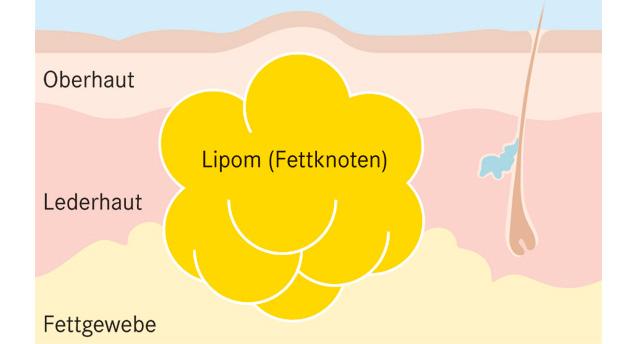 Gutartige Fettgeschwulste: Ein Blick auf die Entstehung und Behandlung von Lipomen Gutartige Fettgeschwulste: Ein Blick auf die Entstehung und Behandlung von Lipomen