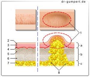 Lipome: Gutartige Fetttumore unter der Haut - Ursachen, Symptome und Therapieansätze