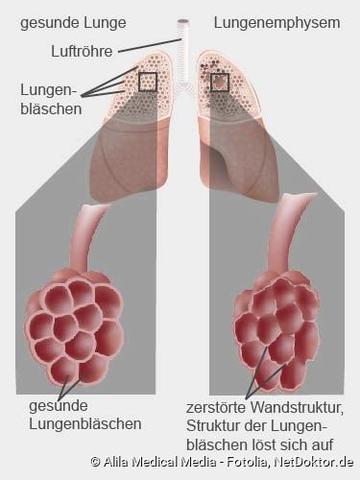 Lungenemphysem: Definition, Auswirkungen und Behandlung Lungenemphysem: Definition, Auswirkungen und Behandlung