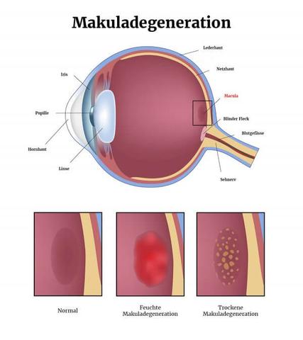 Risikofaktoren für Makuladegeneration: Ursachen und Prävention Risikofaktoren für Makuladegeneration: Ursachen und Prävention