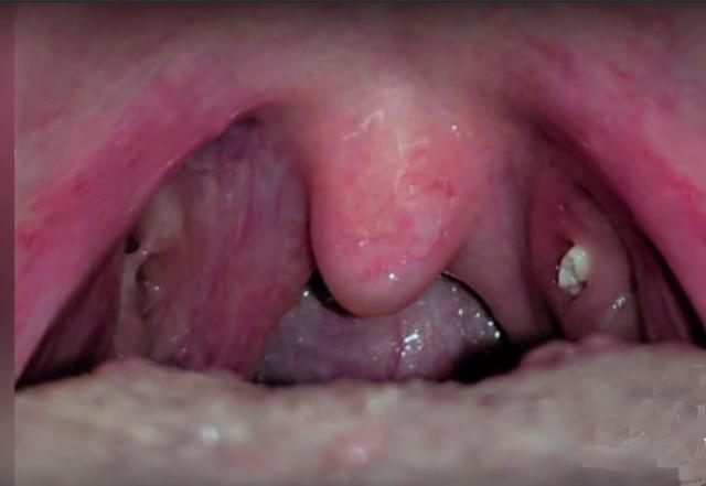 Natürliche Methoden zur Entfernung von Mandelsteinen Natürliche Methoden zur Entfernung von Mandelsteinen