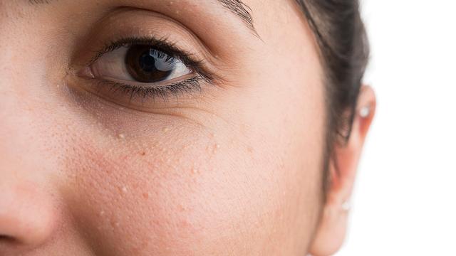 Hausmittel gegen Milien: Natürliche Methoden zur Entfernung von Hautzysten