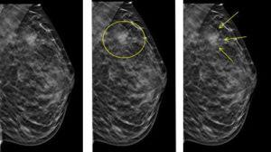 3. Behandlungsmöglichkeiten für bösartige Mikroverkalkungen in der Brust