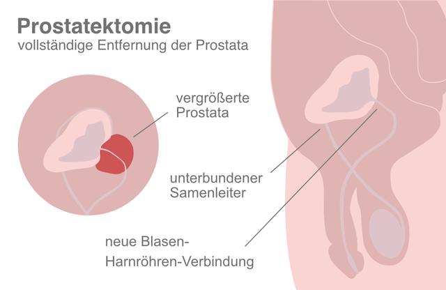 Auto fahren nach einer Operation an der Prostata: Empfehlungen und Richtlinien