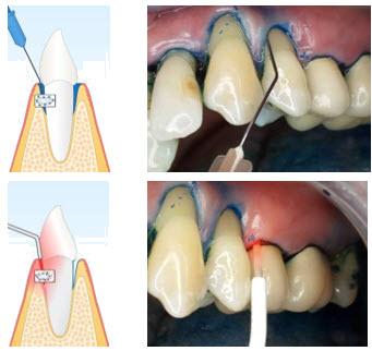Effektive Methoden zur Selbstbehandlung von Parodontitis