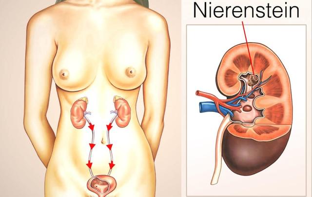 Aktive Maßnahmen gegen Nierensteine Aktive Maßnahmen gegen Nierensteine