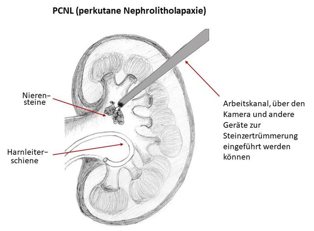 Vorbeugung und Behandlung von Nierensteinen: Tipps und Tricks Vorbeugung und Behandlung von Nierensteinen: Tipps und Tricks
