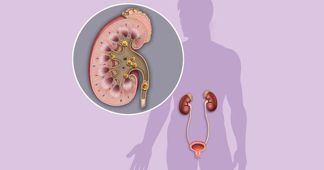 Selbsthilfe bei Nierensteinen: Maßnahmen und Empfehlungen Selbsthilfe bei Nierensteinen: Maßnahmen und Empfehlungen