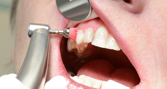 Natürliche Wege zur Behandlung von Parodontose: Tipps für eine selbstständige Therapie