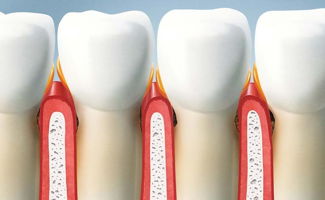 Vorbeugung und Behandlung von Parodontose in Eigenregie: Tipps und Tricks für zu Hause