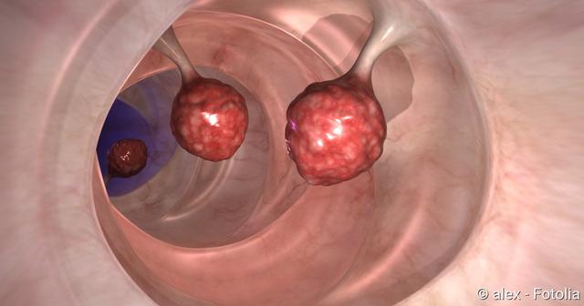 6. Wichtige Informationen über Peutz-Jeghers-Syndrom und familiäre juvenile Polyposis 6. Wichtige Informationen über Peutz-Jeghers-Syndrom und familiäre juvenile Polyposis