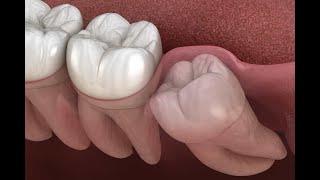 Was Sie nach einer Zahn-OP mit Naht essen sollten