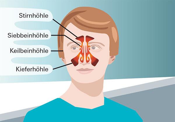 Schnelle Hilfe Bei Nasennebenhöhlenentzündung: Bewährte Hausmittel ...