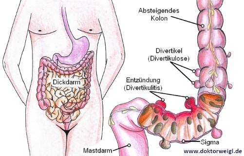 Alles über Sigmadivertikulitis: Entstehung, Häufigkeit und Beschwerden Alles über Sigmadivertikulitis: Entstehung, Häufigkeit und Beschwerden