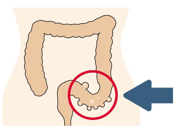 Sigmadivertikulitis: Ursachen, Symptome und Behandlung der Erkrankung Sigmadivertikulitis: Ursachen, Symptome und Behandlung der Erkrankung