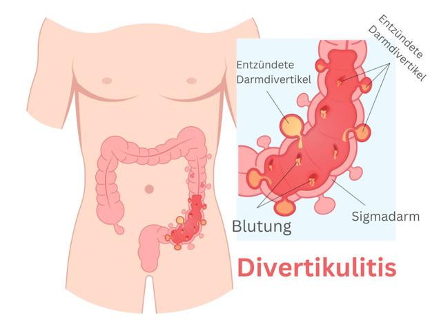 Sigmadivertikulitis: Symptome, Diagnose und mögliche Behandlungen im Überblick Sigmadivertikulitis: Symptome, Diagnose und mögliche Behandlungen im Überblick