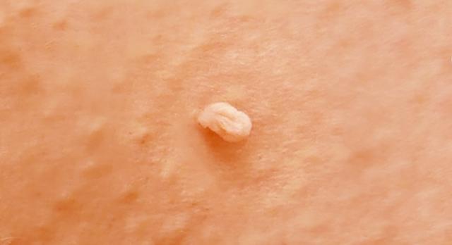 Stielwarzen selbst behandeln: Wirksame Hausmittel und Produkte aus der Apotheke Stielwarzen selbst behandeln: Wirksame Hausmittel und Produkte aus der Apotheke