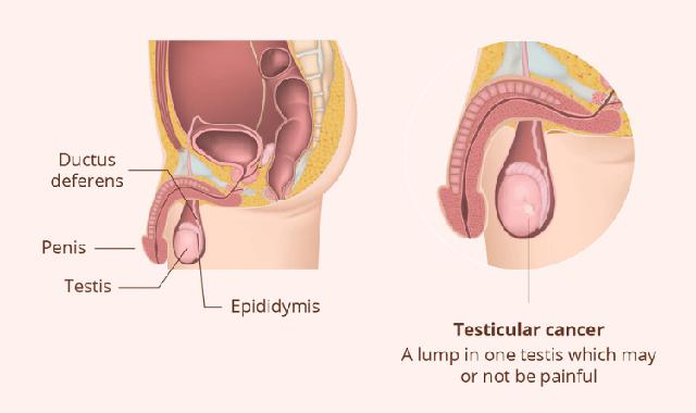 Hodenkrebs oder harmlose Beschwerden? Wann sollte man zum Arzt gehen? Hodenkrebs oder harmlose Beschwerden? Wann sollte man zum Arzt gehen?