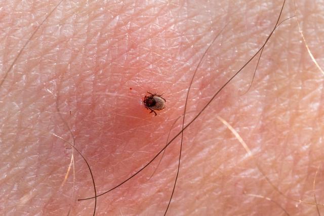 Richtig handeln bei einem Zeckenbiss: Anleitungen und Empfehlungen Richtig handeln bei einem Zeckenbiss: Anleitungen und Empfehlungen