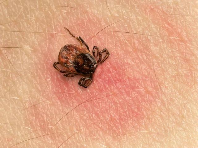Zeckenbiss: Was tun? Wichtige Hinweise und Vorgehensweisen Zeckenbiss: Was tun? Wichtige Hinweise und Vorgehensweisen