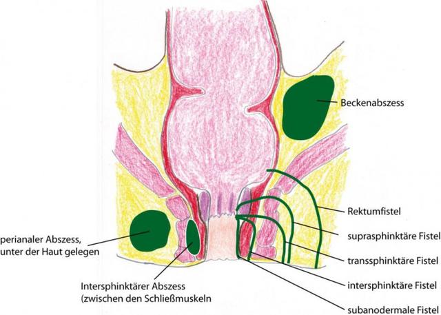 Wo finde ich Hilfe bei Fistelbeschwerden? Informationen und Anlaufstellen Wo finde ich Hilfe bei Fistelbeschwerden? Informationen und Anlaufstellen