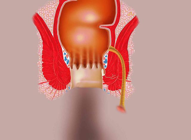 Kostenabdeckung für die Behandlung von Fisteln: Was Sie beachten sollten Kostenabdeckung für die Behandlung von Fisteln: Was Sie beachten sollten