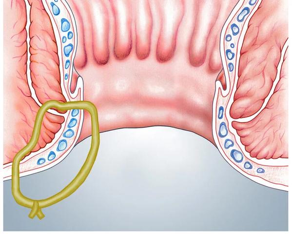 Behandlungsmöglichkeiten für Fisteln: Was Sie wissen sollten Behandlungsmöglichkeiten für Fisteln: Was Sie wissen sollten