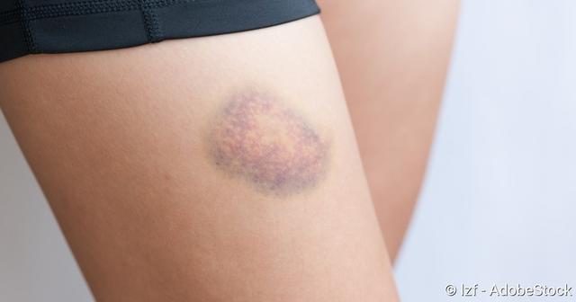 Hämatome: Entstehung, Sichtbarkeit und Behandlungsmöglichkeiten Hämatome: Entstehung, Sichtbarkeit und Behandlungsmöglichkeiten