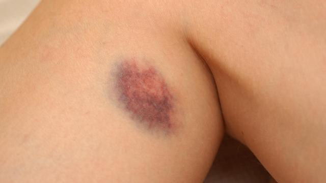 Alles über Hämatome: Von Brüchen bis Prellungen Alles über Hämatome: Von Brüchen bis Prellungen