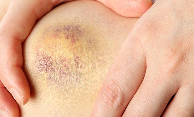 Organisierte Hämatome: Schmerzhafte Folgen und chirurgische Eingriffe Organisierte Hämatome: Schmerzhafte Folgen und chirurgische Eingriffe