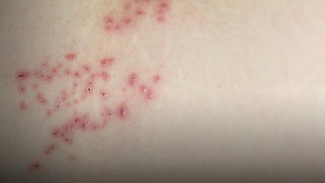 Die Rolle von Kaffee bei der Behandlung von Gürtelrose