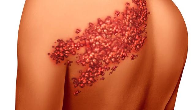 Gesundheitsrisiken: Warum kein Kaffee bei Gürtelrose