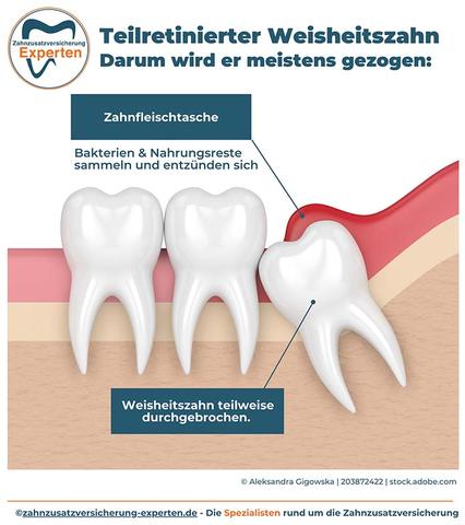 Welche Komplikationen können bei Weisheitszähnen auftreten? Welche Komplikationen können bei Weisheitszähnen auftreten?