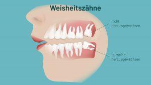 Welche Probleme können auftreten, wenn die Weisheitszähne nicht gezogen werden? Welche Probleme können auftreten, wenn die Weisheitszähne nicht gezogen werden?