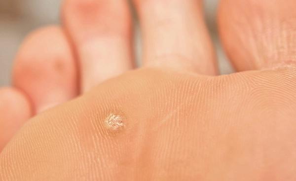 Warzenbehandlung: Ab wann gilt eine Warze als vollständig entfernt? Warzenbehandlung: Ab wann gilt eine Warze als vollständig entfernt?