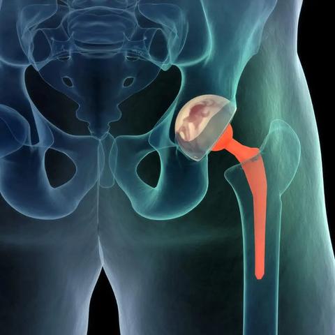 Künstliches Hüftgelenk oder alternative Behandlungsmethoden: Wann ist welche Option die beste? Künstliches Hüftgelenk oder alternative Behandlungsmethoden: Wann ist welche Option die beste?