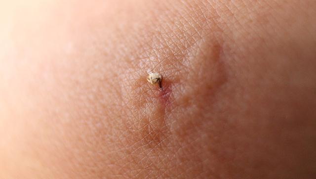 Was hilft bei stark geschwollenen Bienenstichen? Was hilft bei stark geschwollenen Bienenstichen?