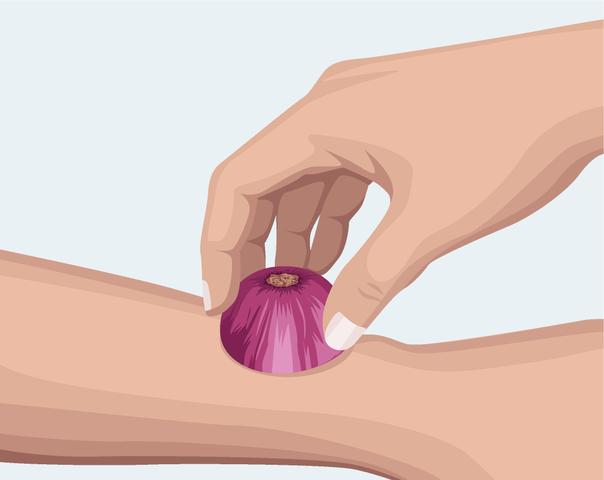 Wie lange dauert es, bis ein Bienenstich abschwillt? Wie lange dauert es, bis ein Bienenstich abschwillt?