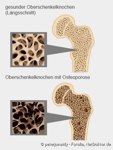 Ab wann ist Osteoporose eine ernsthafte Bedrohung für die Gesundheit?
