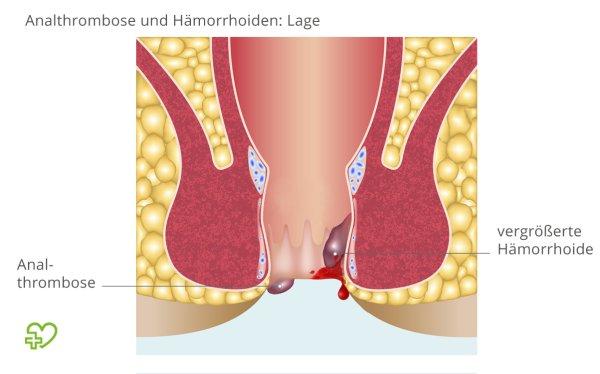 Bettruhe bei Analthrombose: Wie sie Schmerzen lindern und den Genesungsprozess unterstützen kann Bettruhe bei Analthrombose: Wie sie Schmerzen lindern und den Genesungsprozess unterstützen kann