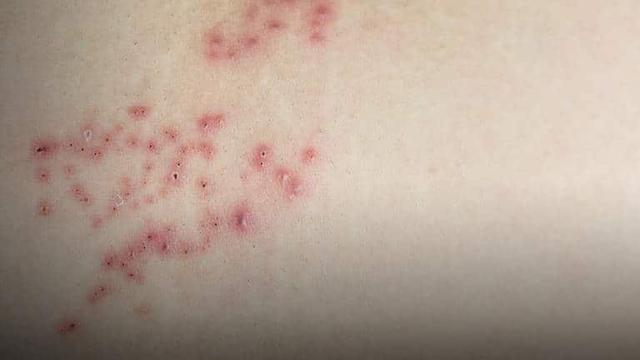 Gürtelrose und Kaffee: Warum es ratsam ist, während der Erkrankung darauf zu verzichten Gürtelrose und Kaffee: Warum es ratsam ist, während der Erkrankung darauf zu verzichten