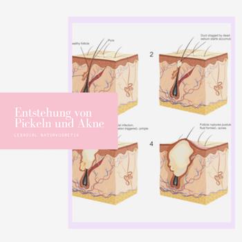Was passiert, wenn man Eiterpickel nicht richtig behandelt?