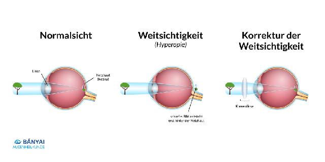 Weitsichtigkeit verstehen: Ursachen, Auswirkungen und Behandlungsmöglichkeiten. Weitsichtigkeit verstehen: Ursachen, Auswirkungen und Behandlungsmöglichkeiten.