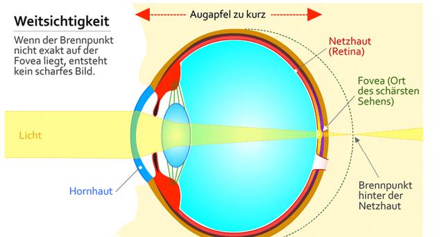 Ursachen und Symptome von Weitsichtigkeit: Was Sie wissen sollten. Ursachen und Symptome von Weitsichtigkeit: Was Sie wissen sollten.