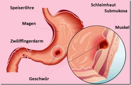 Gesunde Ernährung bei Magengeschwüren: Tipps und Empfehlungen Gesunde Ernährung bei Magengeschwüren: Tipps und Empfehlungen