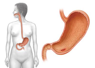 Magengeschwür: Wie Sie Ihre Ernährung anpassen sollten Magengeschwür: Wie Sie Ihre Ernährung anpassen sollten
