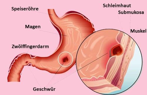 Tee und gesunde Ernährung bei Magengeschwüren: Die besten Tipps für eine schnelle Genesung Tee und gesunde Ernährung bei Magengeschwüren: Die besten Tipps für eine schnelle Genesung
