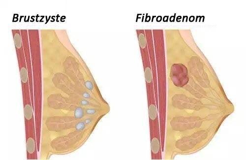 Hilfreiche Maßnahmen gegen Brustzysten: Was kann helfen?