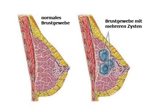 Behandlungsmöglichkeiten bei Zysten in der Brust: Was wirklich wirkt