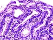 Einblicke in Adenome: Entstehung und mögliche Folgen